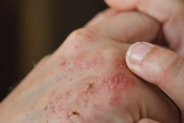 小兒手上有濕疹能夠徹底治愈嗎(圖4)