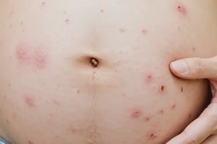 孕婦四肢偶爾起濕疹不管它會自己自愈嗎(圖4)