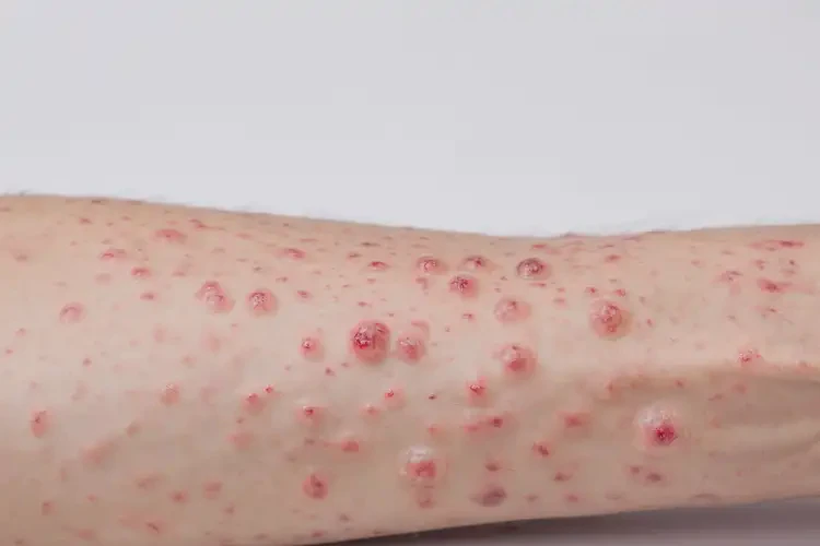 男人小腿偶爾長濕疹不管它會自己自愈嗎(圖4)