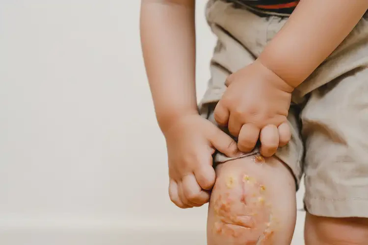 孩子全身偶爾起濕疹不管它會自己痊愈嗎(圖2)