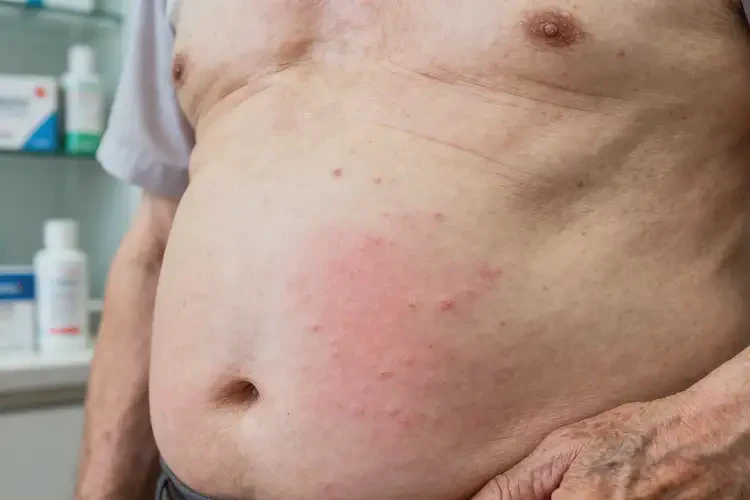 老人肚子上出現(xiàn)濕疹不管它會(huì)自己自愈嗎(圖3)