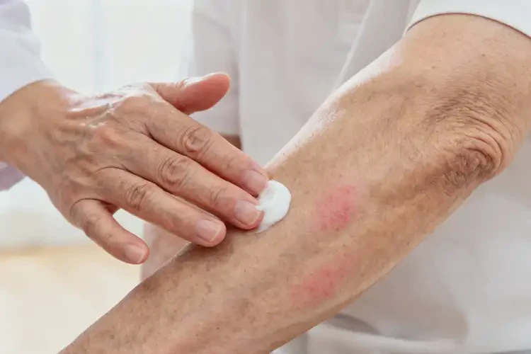 高齡老人手臂偶爾長濕疹不管它會(huì)自己好嗎(圖2)