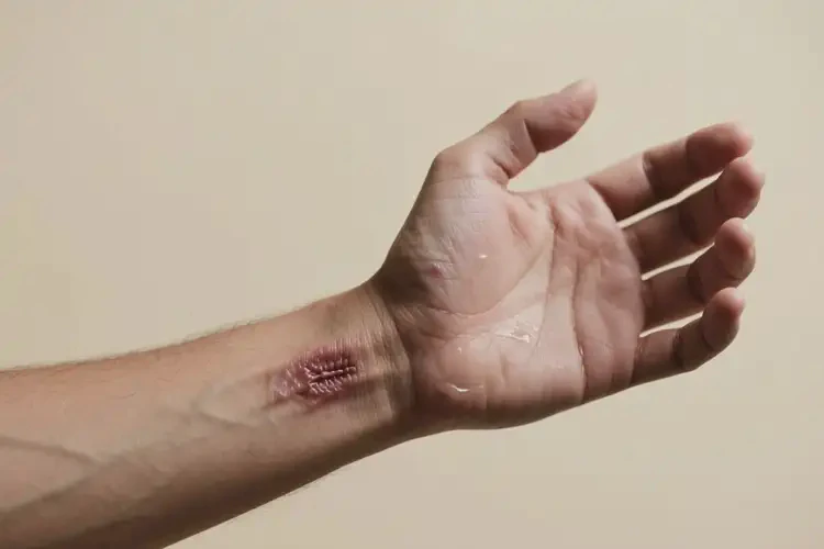 男性手臂上容易起濕疹不管它會自己痊愈嗎(圖2)