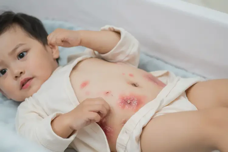 幼兒肚子上經(jīng)常長(zhǎng)濕疹能靠自己自愈嗎(圖4)