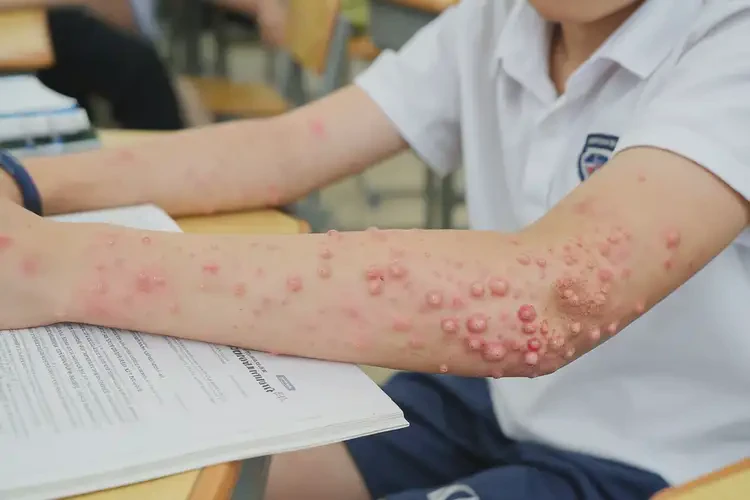 中學(xué)生四肢出濕疹能靠自己自愈嗎(圖4)