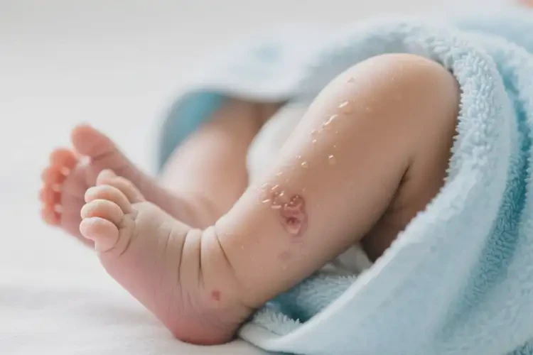 新生兒小腿上長濕疹可不可以徹底自愈(圖3)