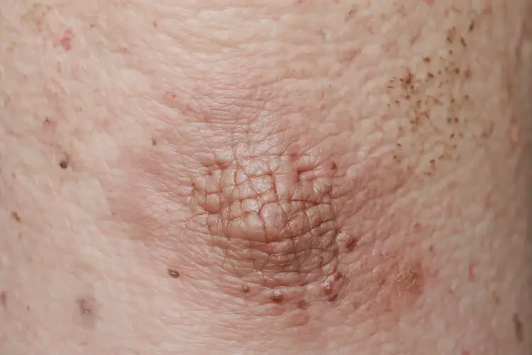 女生腳上起濕疹可不可以徹底自愈(圖2)