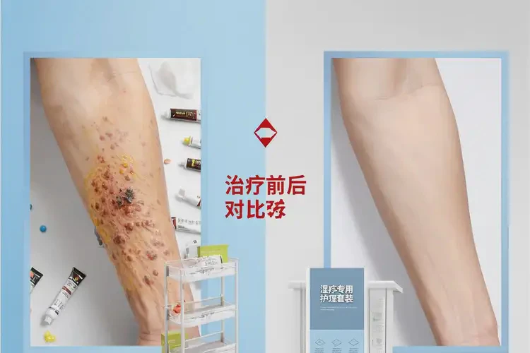 女生肚子出濕疹不管它會自己自愈嗎(圖1)