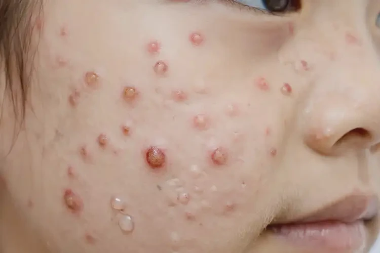 青少年面部出現(xiàn)濕疹可以徹底自愈嗎(圖4)