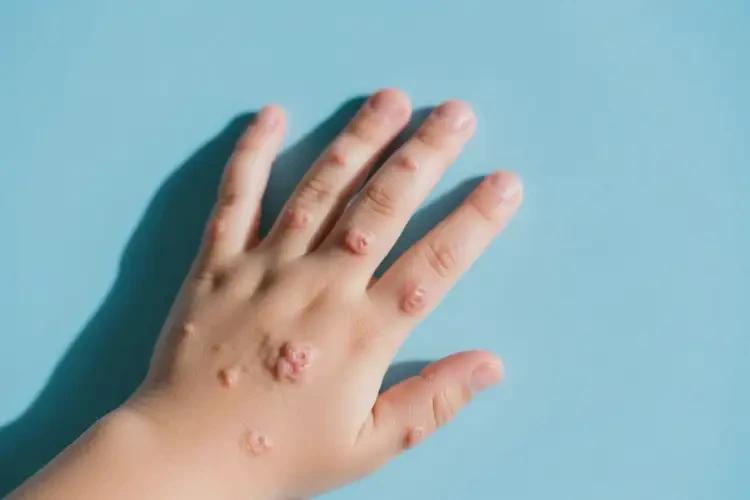 小孩手上出濕疹不管它會自己自愈嗎(圖1)