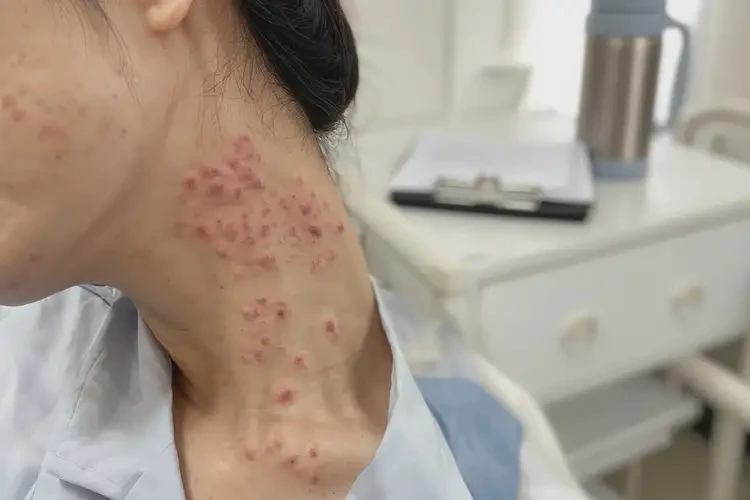 产妇脖子经常长湿疹能够彻底治愈吗(图4)