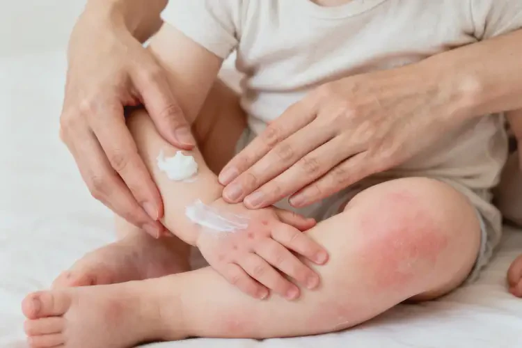 嬰幼兒四肢出濕疹可不可以徹底自愈(圖1)