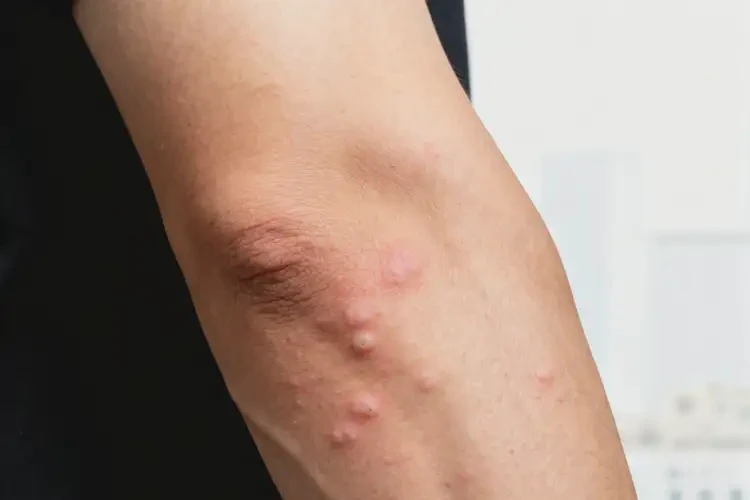 男性手臂偶爾長(zhǎng)濕疹不管它會(huì)自己好嗎(圖3)