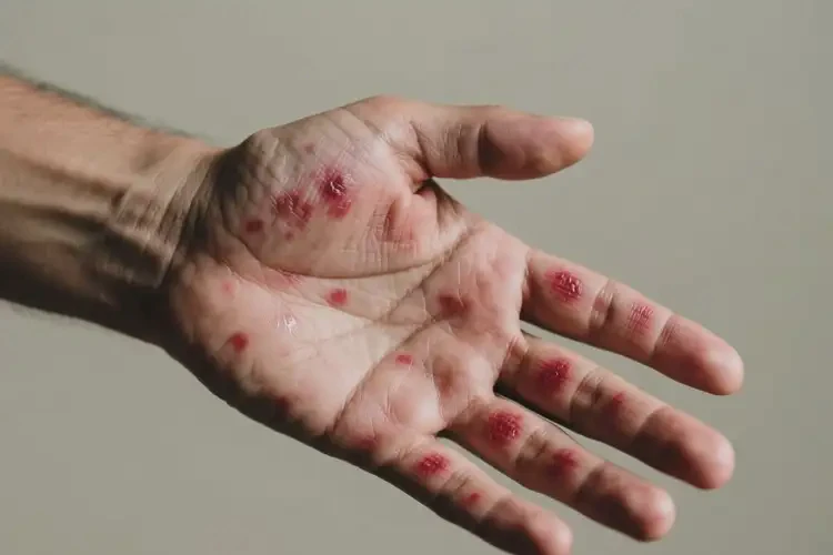 男性手上經(jīng)常長濕疹不管它會(huì)自己痊愈嗎(圖1)