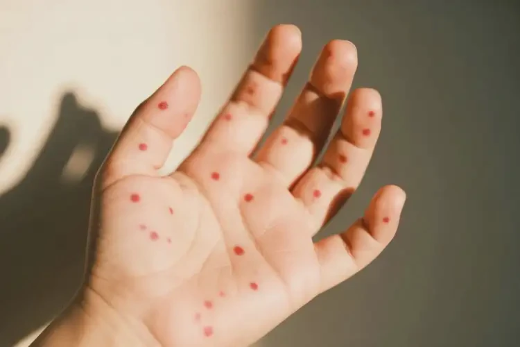 小孩手上偶爾起濕疹能徹底自愈嗎(圖3)