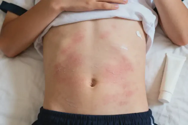 中學生肚子有濕疹能夠徹底治愈嗎(圖2)