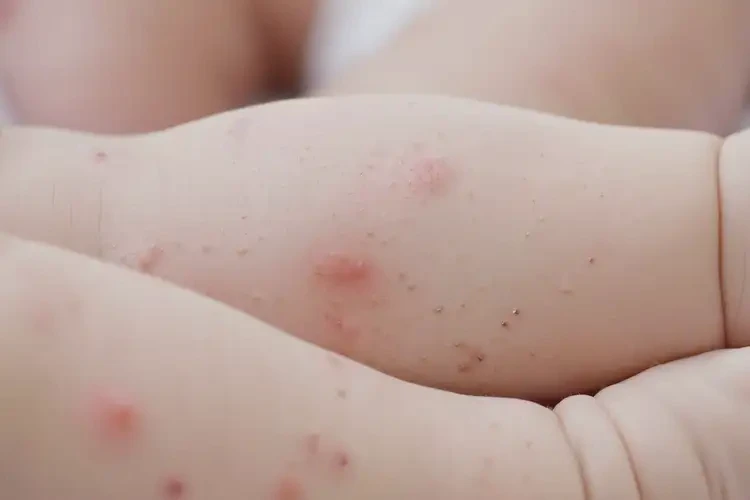 寶寶四肢起濕疹能夠徹底治愈嗎(圖3)