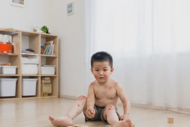 小孩小腿上出濕疹可不可以徹底自愈(圖4)