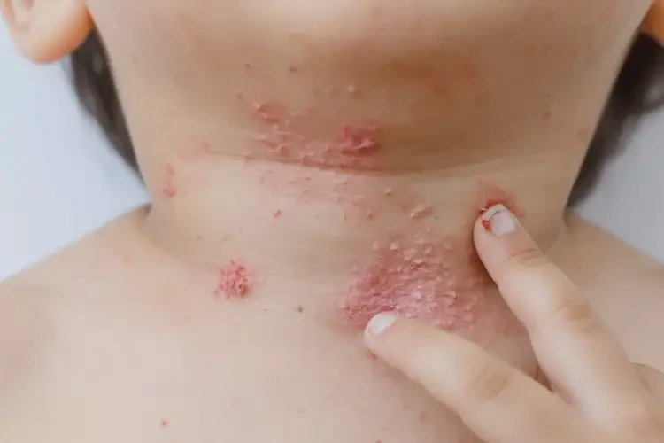 兒童脖子上經(jīng)常長(zhǎng)濕疹不管它會(huì)自己好嗎(圖4)