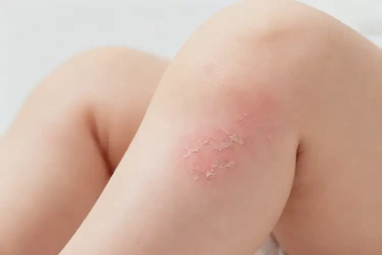 新生兒小腿上容易起濕疹不管它會(huì)自己自愈嗎(圖1)