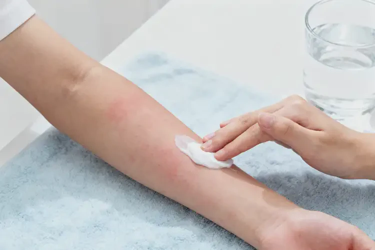 青少年四肢長(zhǎng)濕疹可不可以徹底自愈(圖3)