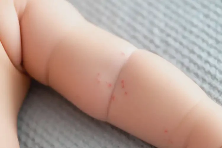 嬰兒手臂偶爾長濕疹不管它會自己好嗎(圖2)