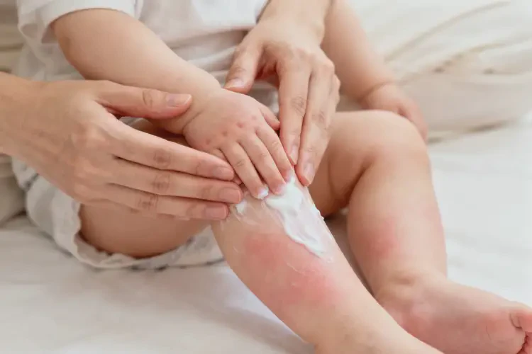 嬰幼兒四肢出濕疹可不可以徹底自愈(圖2)