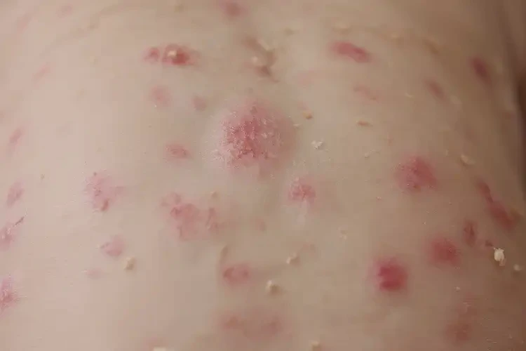 小兒全身有濕疹不管它會(huì)自己好嗎(圖4)