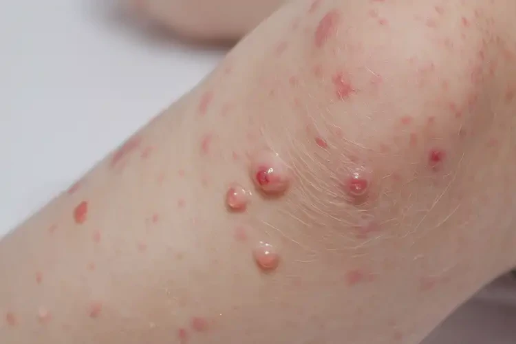 少兒小腿上出現(xiàn)濕疹不管它會(huì)自己好嗎(圖4)