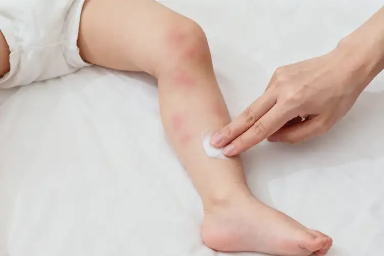 少兒小腿出濕疹能徹底自愈嗎(圖4)