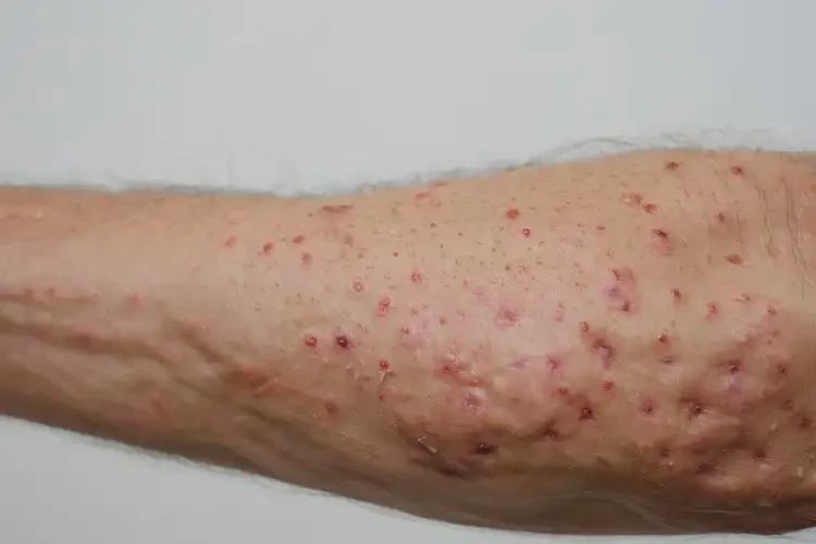 老年人全身出濕疹不管它會(huì)自己自愈嗎(圖4)