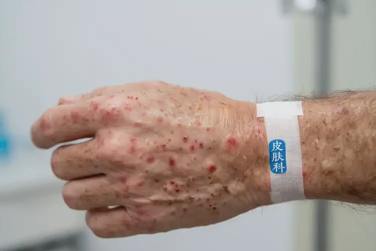 男生手上偶爾長濕疹可不可以徹底自愈(圖4)