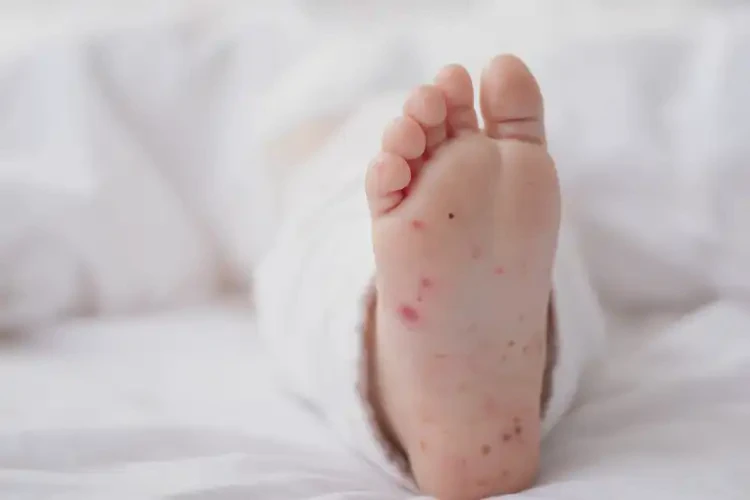 婴儿脚上偶尔起湿疹不管它会自己好吗(图3)