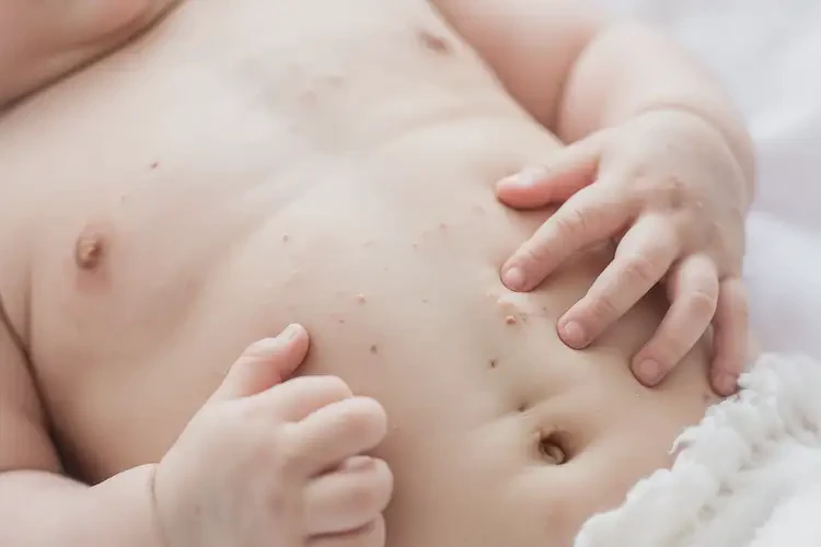 小學生肚子出濕疹能夠徹底治愈嗎(圖4)