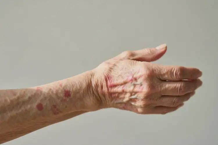 老人手臂上偶爾起濕疹不管它會(huì)自己痊愈嗎(圖2)