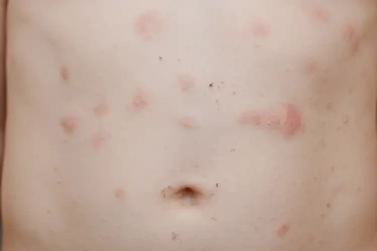 兒童肚子有濕疹可不可以徹底自愈(圖4)