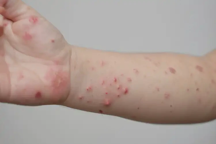 兒童四肢偶爾起濕疹可不可以徹底自愈(圖4)