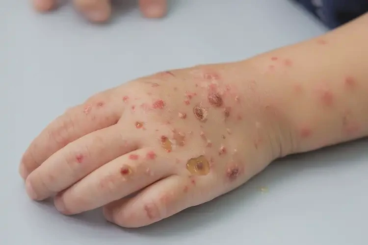 小兒手上偶爾長濕疹不管它會自己自愈嗎(圖3)