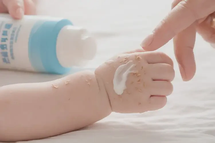 嬰兒手上容易長濕疹能夠徹底治愈嗎(圖3)