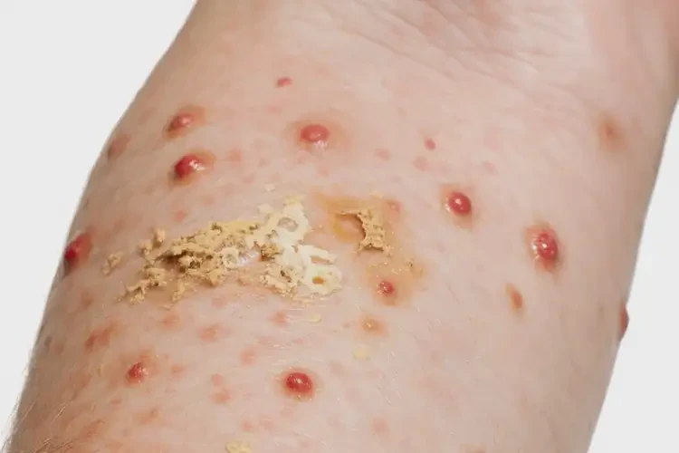 男生四肢出濕疹不管它會(huì)自己好嗎(圖3)