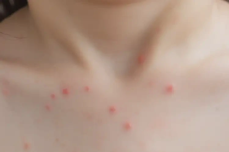 兒童脖子上偶爾長(zhǎng)濕疹不管它會(huì)自己自愈嗎(圖4)