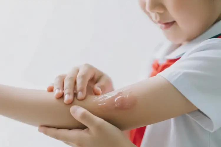小學生手臂容易長濕疹能不能徹底自愈(圖2)