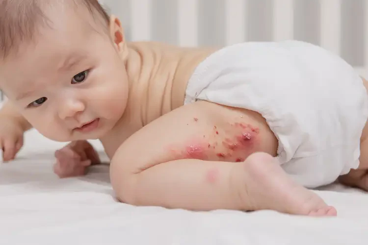 小孩屁股上容易長(zhǎng)濕疹不管它會(huì)自己好嗎(圖4)