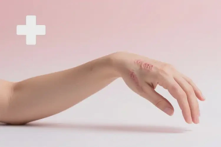 女人手臂上經(jīng)常起濕疹能徹底自愈嗎(圖1)