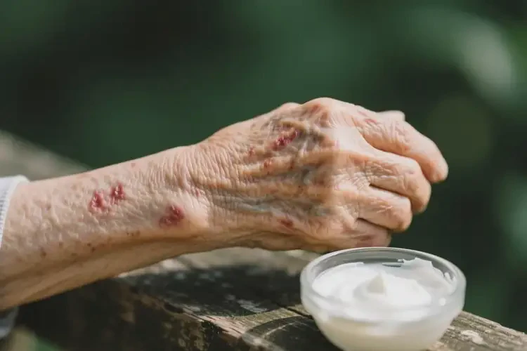 老人手臂長濕疹能徹底自愈嗎(圖2)