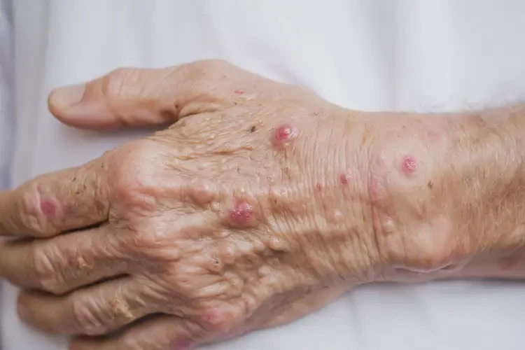 老年人四肢容易長濕疹可不可以徹底自愈(圖4)