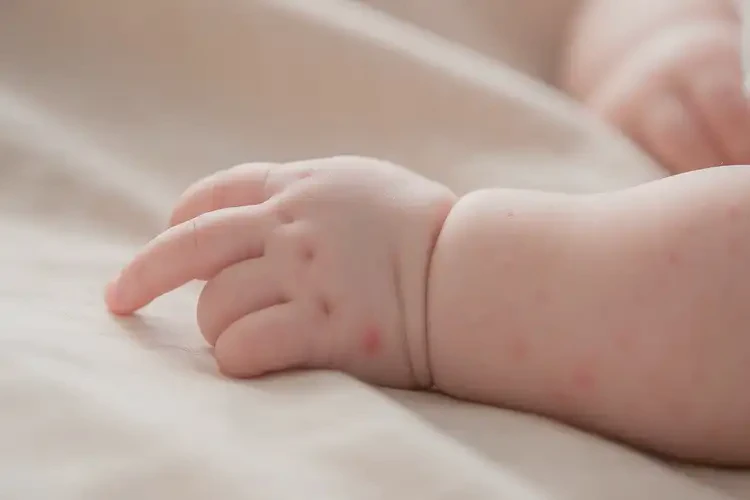 婴幼儿手上偶尔起湿疹能靠自己自愈吗(图1)