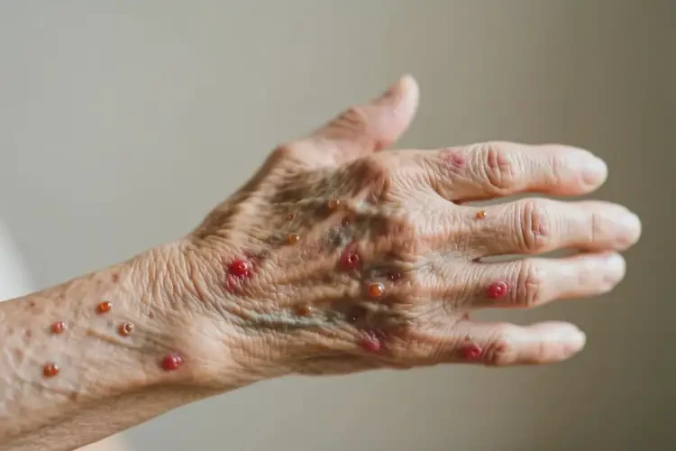 老人手臂上容易起濕疹不管它會自己痊愈嗎(圖3)