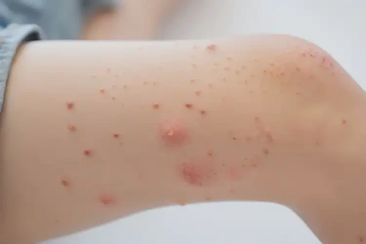 孩子大腿出濕疹能夠徹底治愈嗎(圖4)