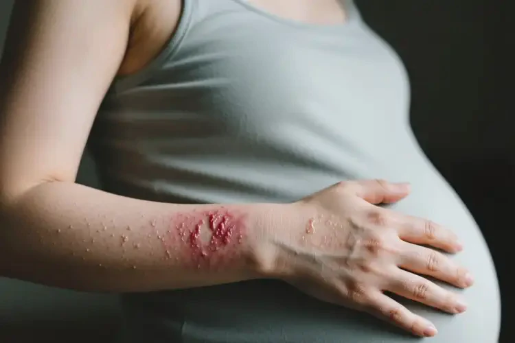 產(chǎn)婦手臂上起濕疹不管它會自己痊愈嗎(圖1)